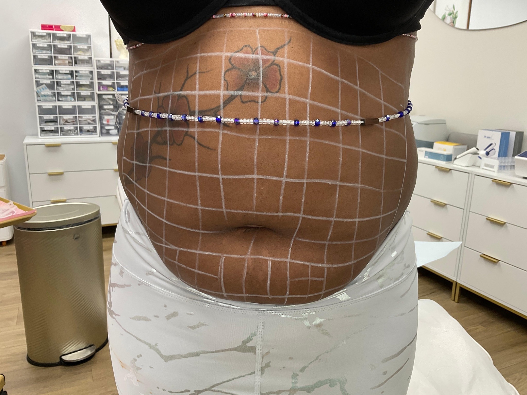 Fat dissolving mapping before