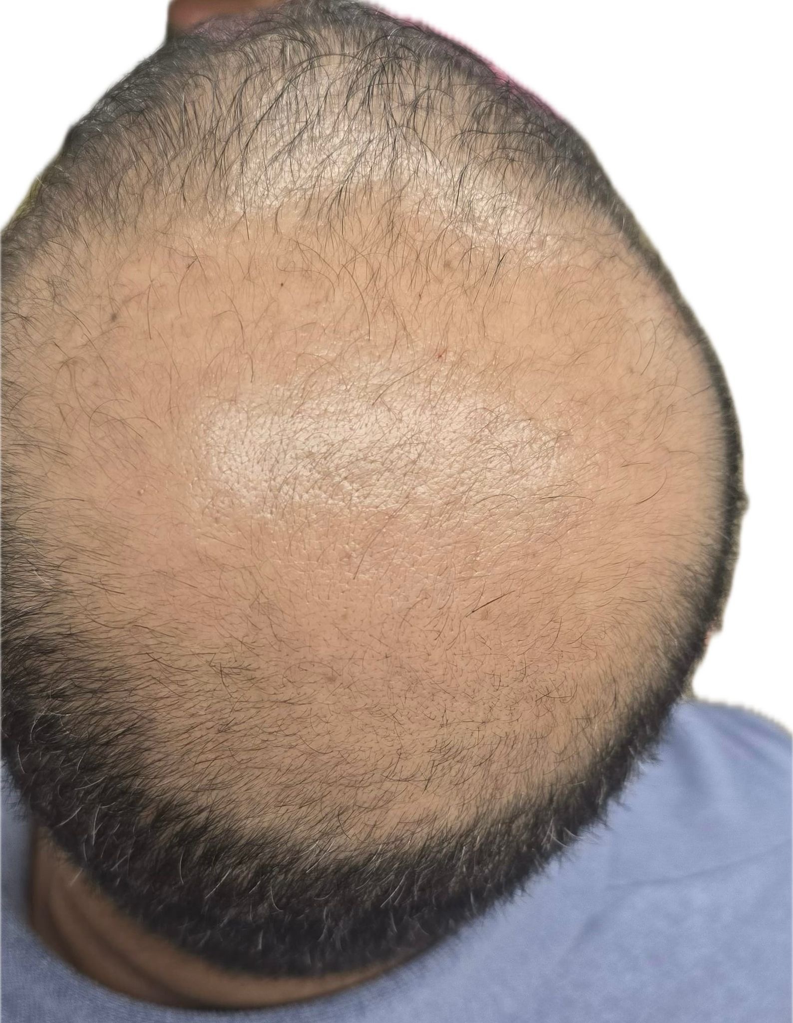 Crown thinning before PRP