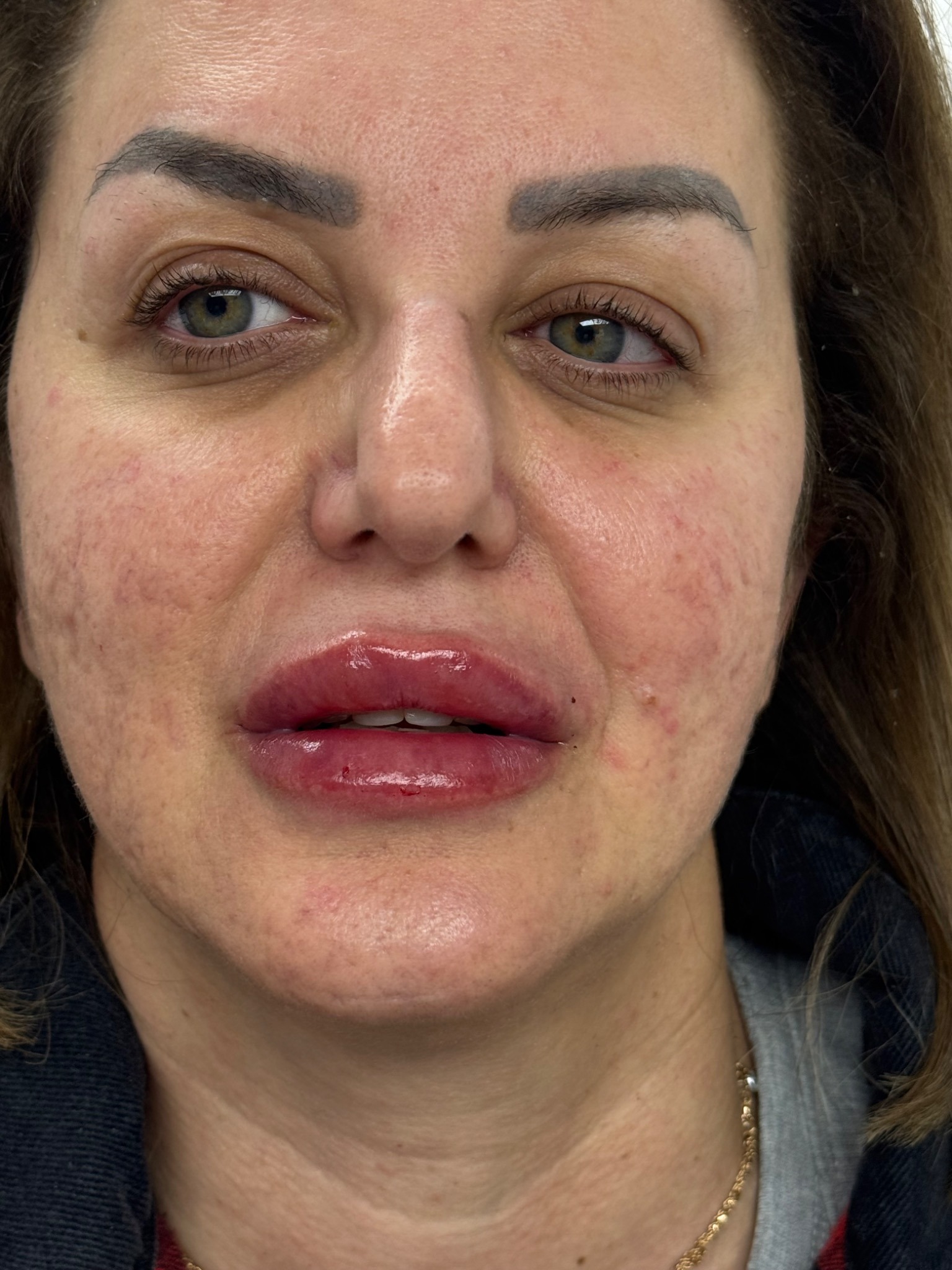 Lips after – Set A