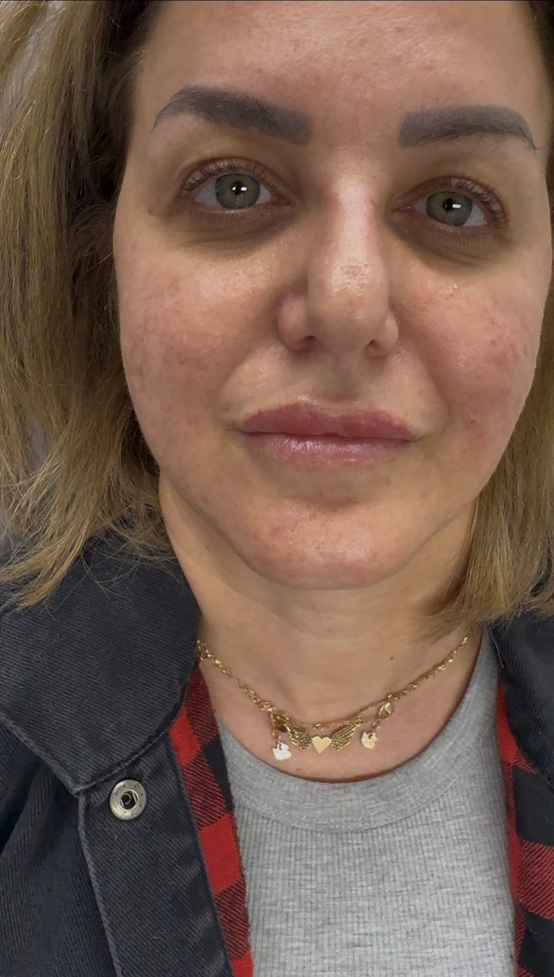 Lips before – Set A