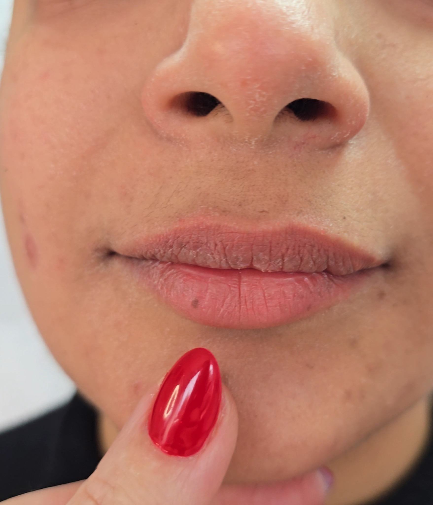 Lips before – Set A