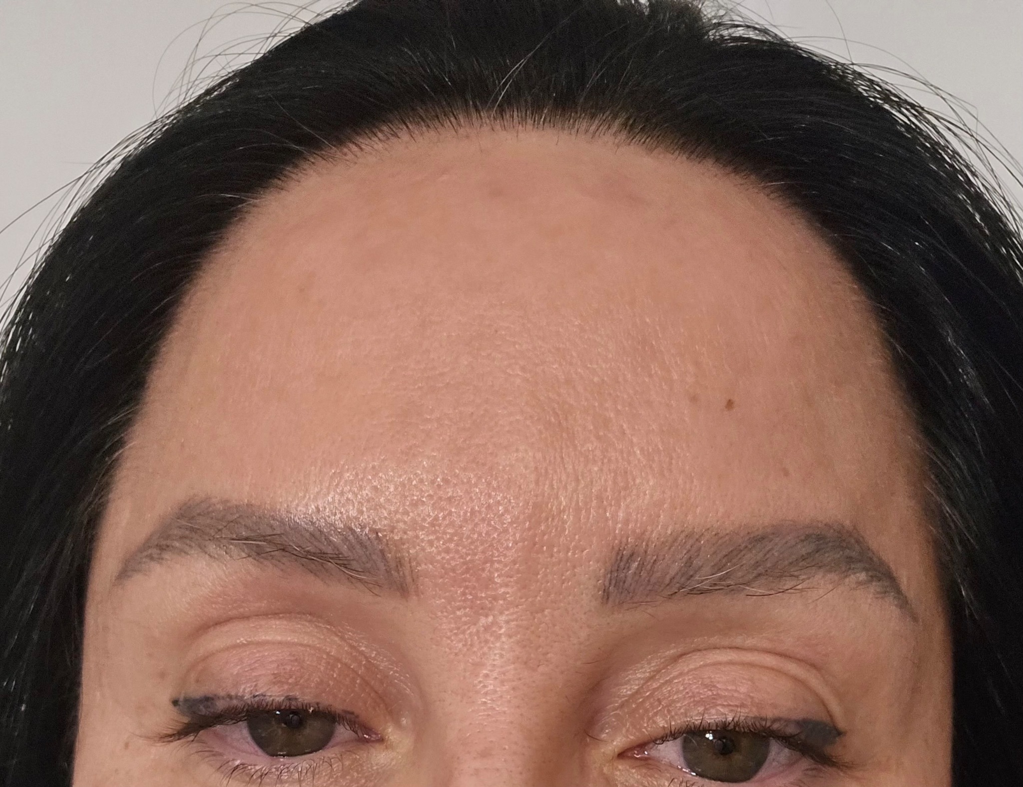 Forehead after neuromodulator